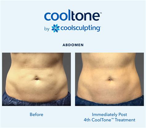 coolsculpting breckenridge|Cooltone™ by Coolsculpting .